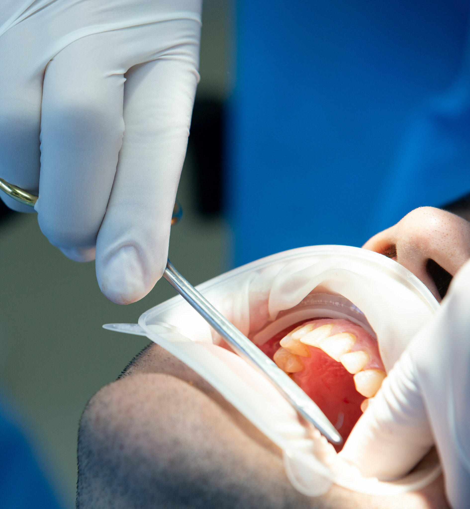 Why Do Leading Clinicians Prefer MBI's Collagen Dental Dressings?