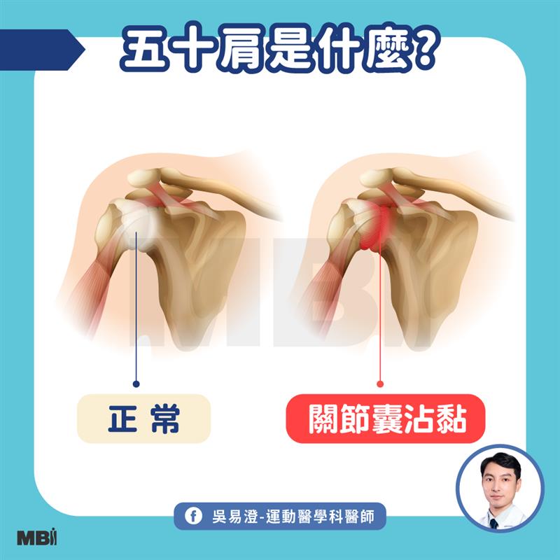 五十肩是什麼
